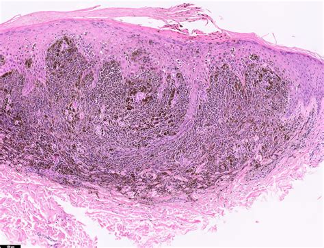 pathology and course of malignat melanoma